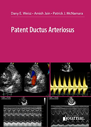 Patent Ductus Arteriosus